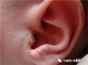 宝宝中耳炎的表现有哪些?