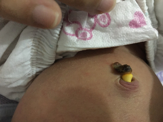 小儿脐疝嵌顿症状图片图片