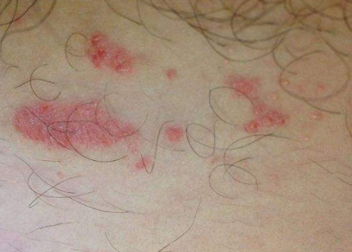 玫瑰糠疹母斑图片 (45)