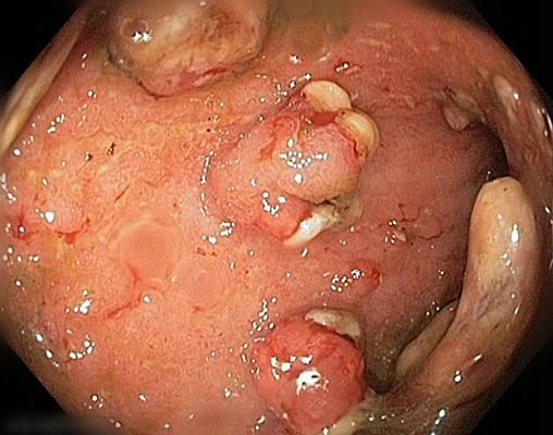 直肠癌肛门肿物图片图片