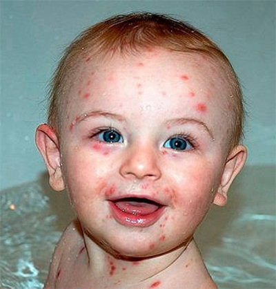 婴儿风疹图片 (33)