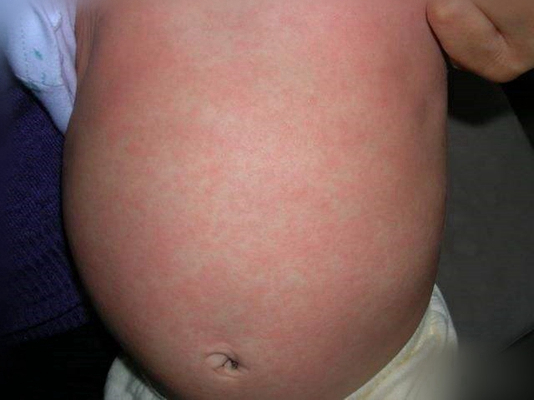 婴儿风疹图片 (74)
