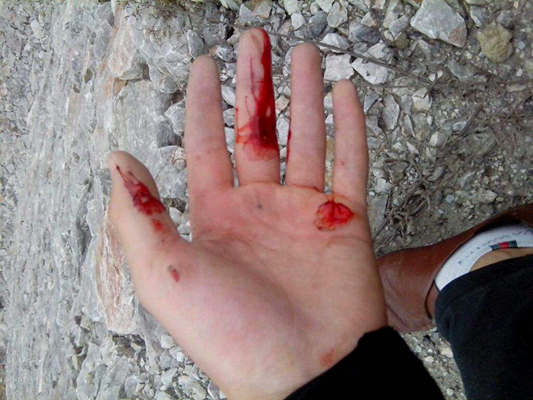 手受伤流血真实图片