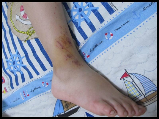 女生脚受伤的真实图片图片