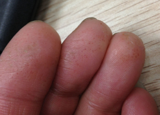 指尖角化性湿疹图片
