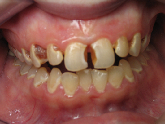 严重骨性龅牙图片图片