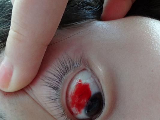 小孩眼睛红血丝图片图片