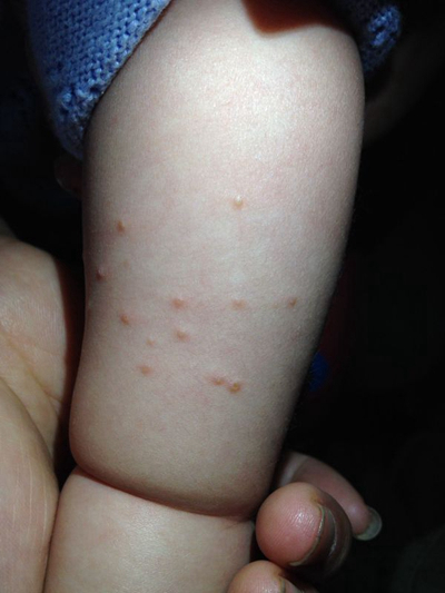 小孩疱疹症状初期图片图片