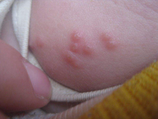 小孩疱疹图片初期症状图片