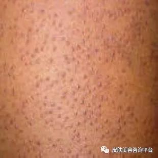 脸部鸡皮肤发黑怎么办(脸部鸡皮肤发黑怎么办图片)