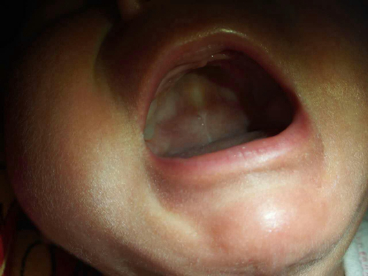 口腔粘膜白斑图片7