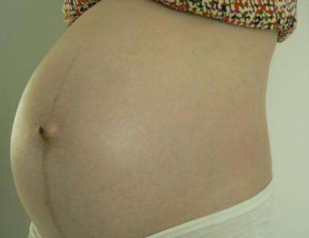 孕妇胆汁淤积症状图片 (36)