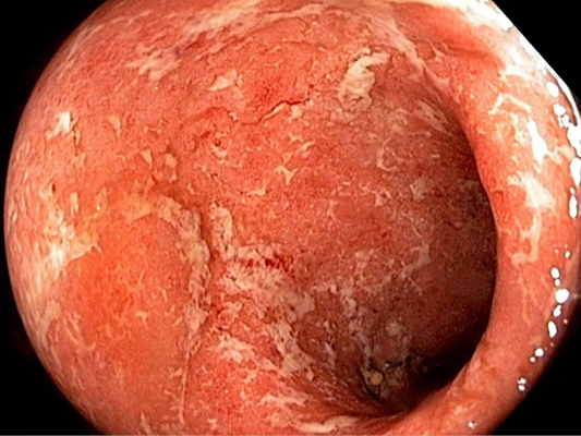 肛管癌早期图片图片