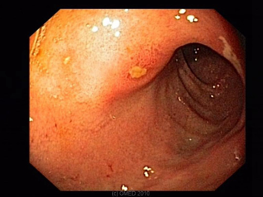 直肠癌肛门肿物图片图片