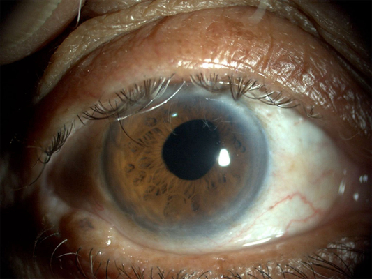 创伤性虹膜睫状体炎图片