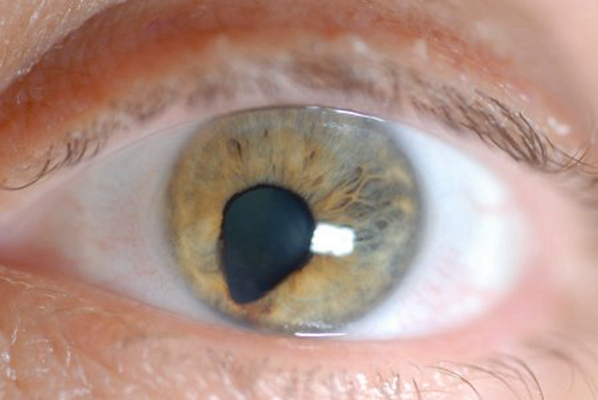 虹膜睫状体炎瞳孔放大图片