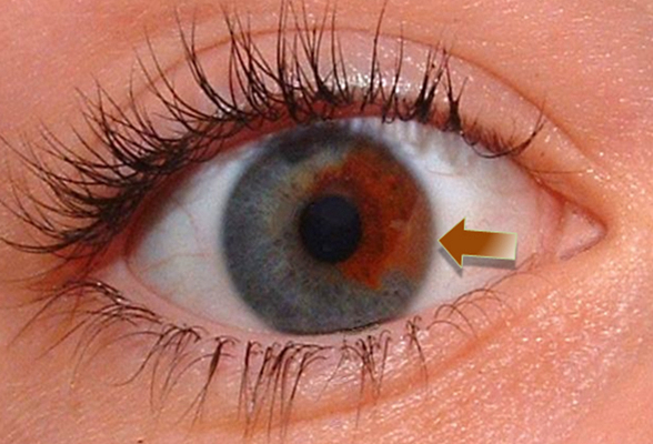 虹膜炎早期症状图片