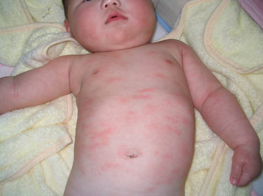 婴儿风疹图片 (55)