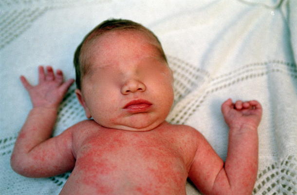 婴儿风疹图片 (42)