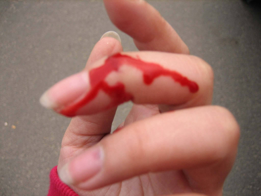 手指伤口图片真实流血图片