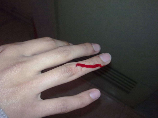 手指针刺伤出血图片图片