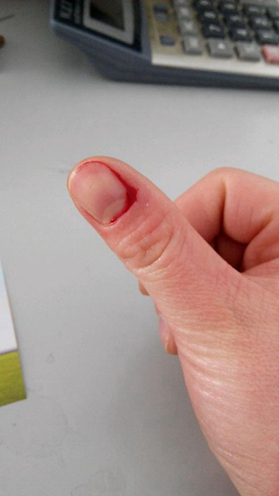 手指毛细血管出血图片图片