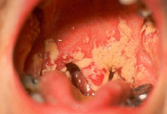 口腔粘膜白斑图片62
