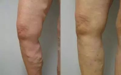 静脉曲张患者平时应该怎样锻炼