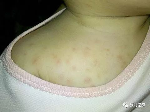 如何有效防治婴儿湿疹?