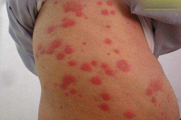 红麻疹的症状图片图片
