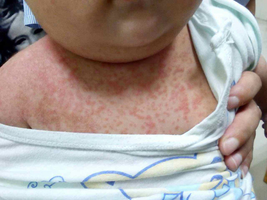 宝宝病毒感染出疹子图图片