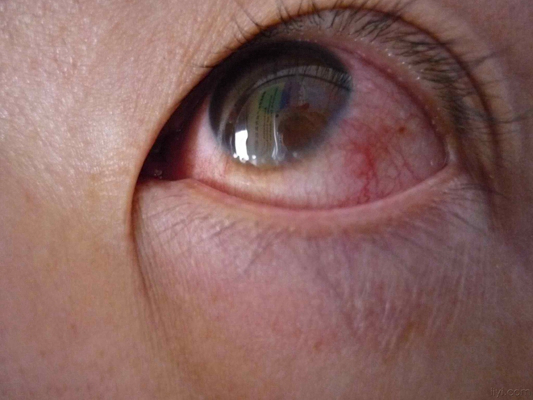 眼癌的早期症状图片 (15)