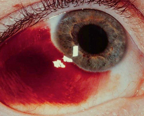 眼癌的早期症状图片 (20)