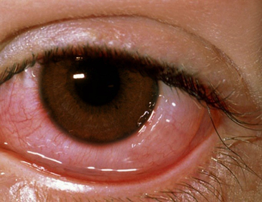 眼癌的早期症状图片 (29)