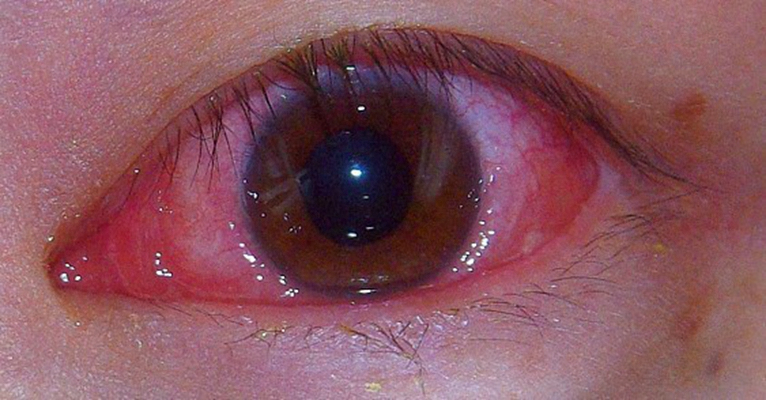 眼癌的早期症状图片 (4)