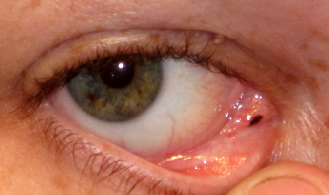 眼睛母细胞瘤早期症状图片