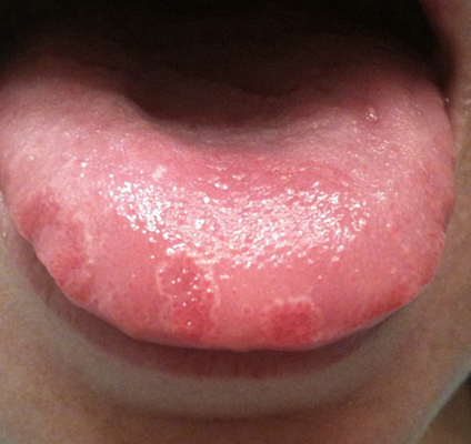 舌头颜色发紫图片胃癌图片