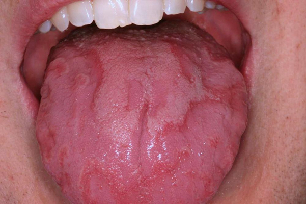 肝癌舌头图片黑紫图片