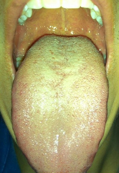 艾滋病舌毛状白斑照片图片