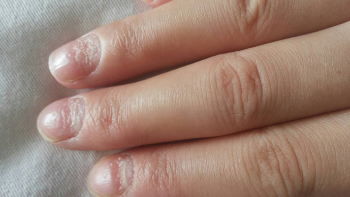 缺钙的指甲图片图片