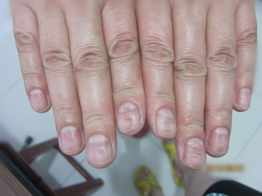 严重缺钙手指甲图片图片