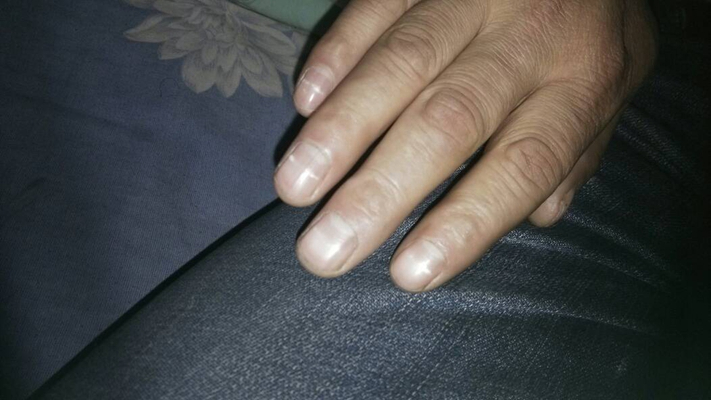 缺钙指甲图片 (5)