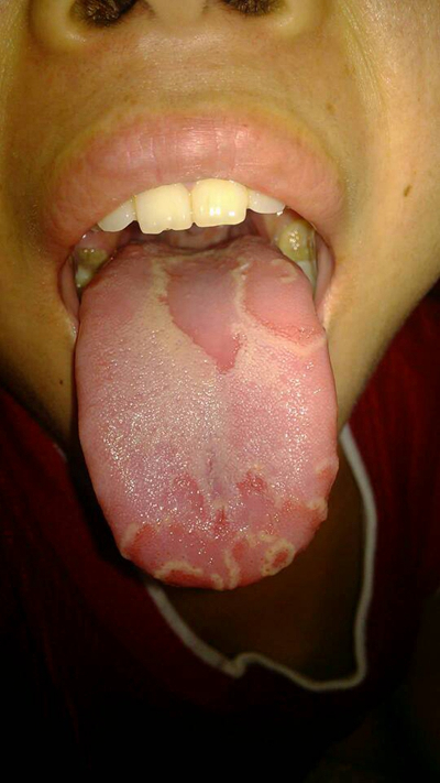艾滋病的舌头白苔图片 (1)