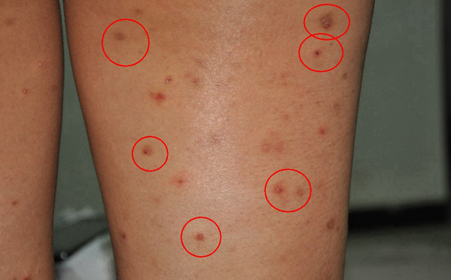 hiv斑疹图片