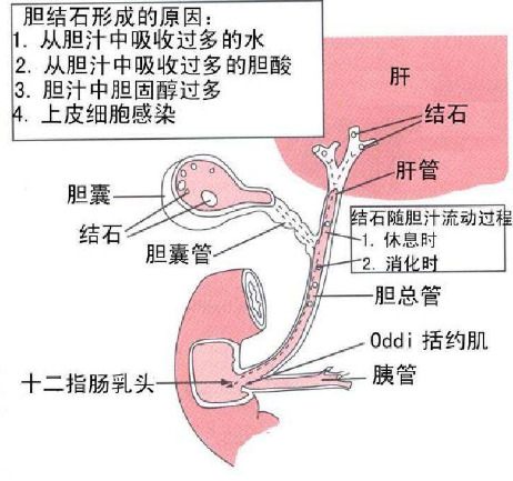 胆结石疼痛部位图 (18)