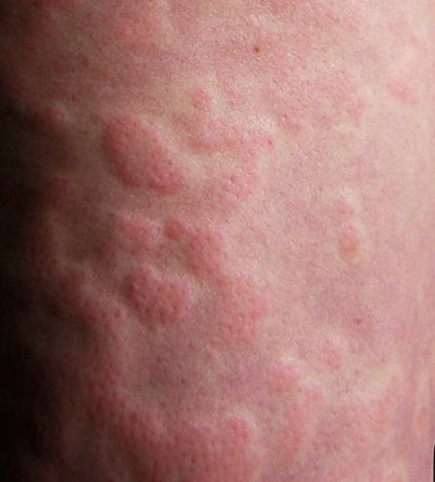秋季荨麻疹图片和症状图片