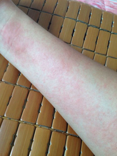 季节性荨麻疹症状图图片