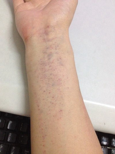 紫癜性血管炎瘀斑图片图片
