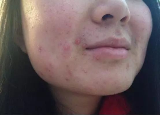 丘疹型痤疮的治疗,护理