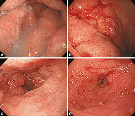胃癌图片 (4)